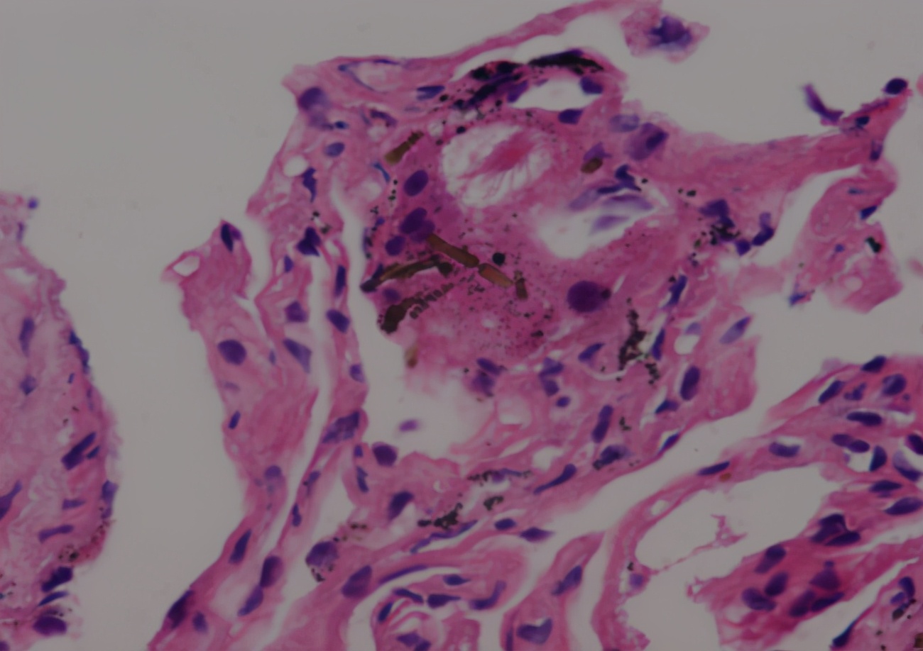 56岁男性发现双肺数百个结节,肺部肿块伴胸腔积液