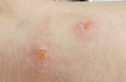 疤痕体质剖腹产如何祛疤,剖腹产后三十多天用什么祛疤