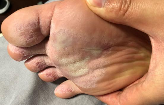 脚丫很臭,脚丫又臭又痒