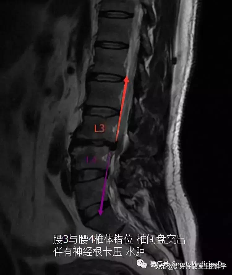 做仰卧起坐真的会腰椎间盘突出吗,仰卧起坐会导致腰椎间盘突出吗