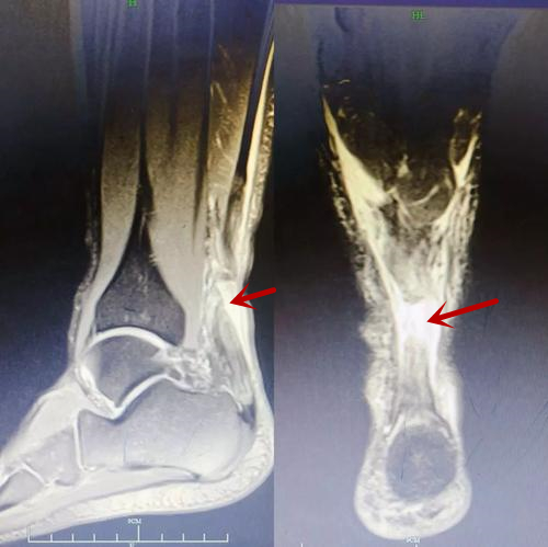 跟腱断裂的早期症状有哪些,诊断跟腱断裂最有效检查方法