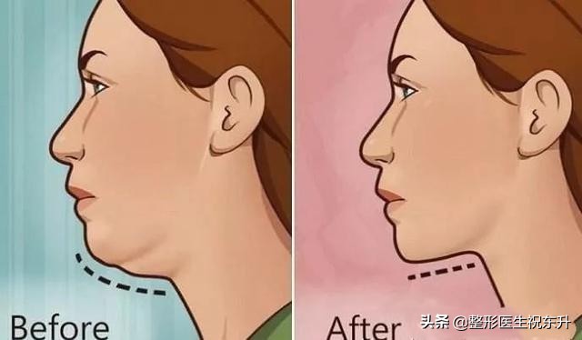 接受不了整形就要正确看待衰老,下颌缘吸脂术后最佳效果多少个月