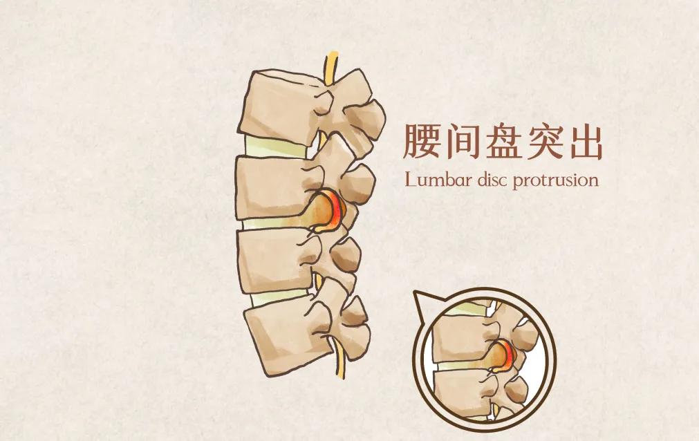 一针治疗腰腿痛视频,一针治疗腰腿痛