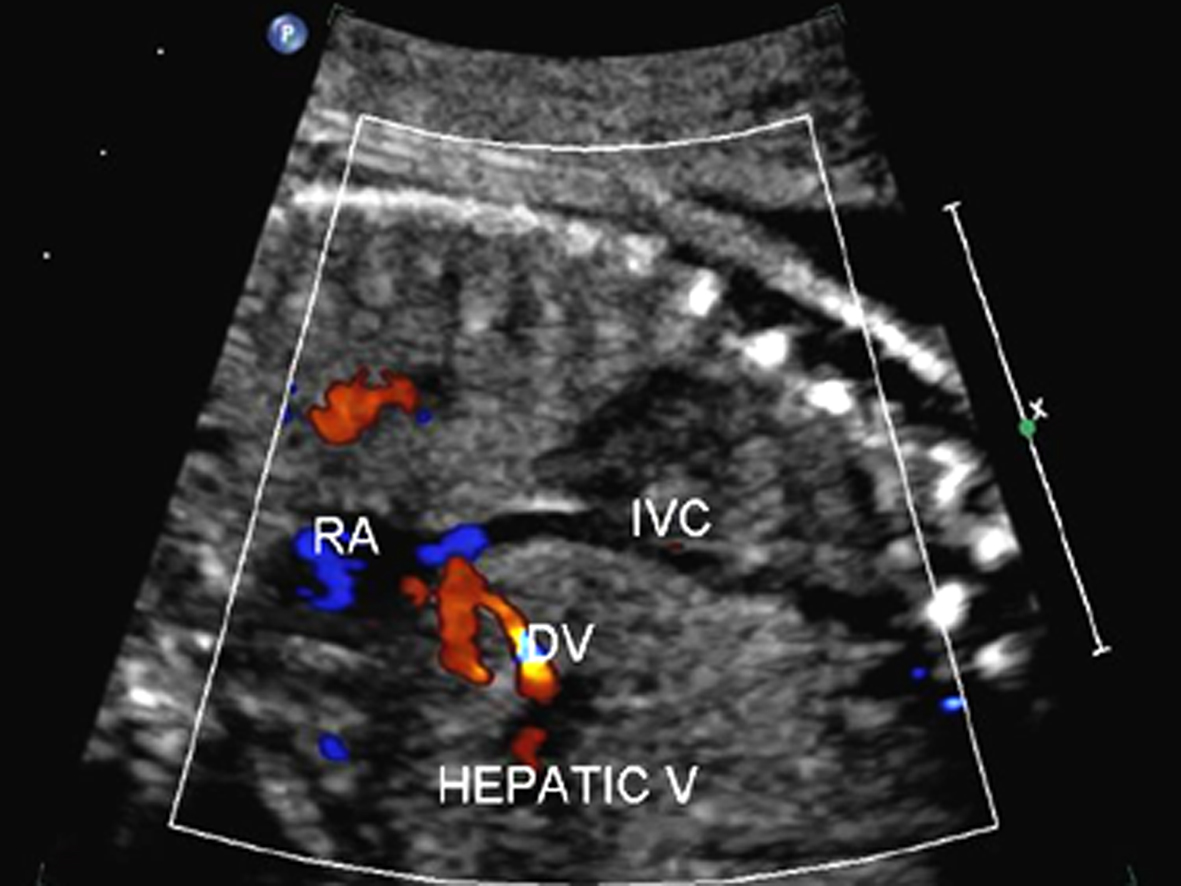 胎儿系统超声检查彩色多普勒,胎儿多普勒超声的一些数据