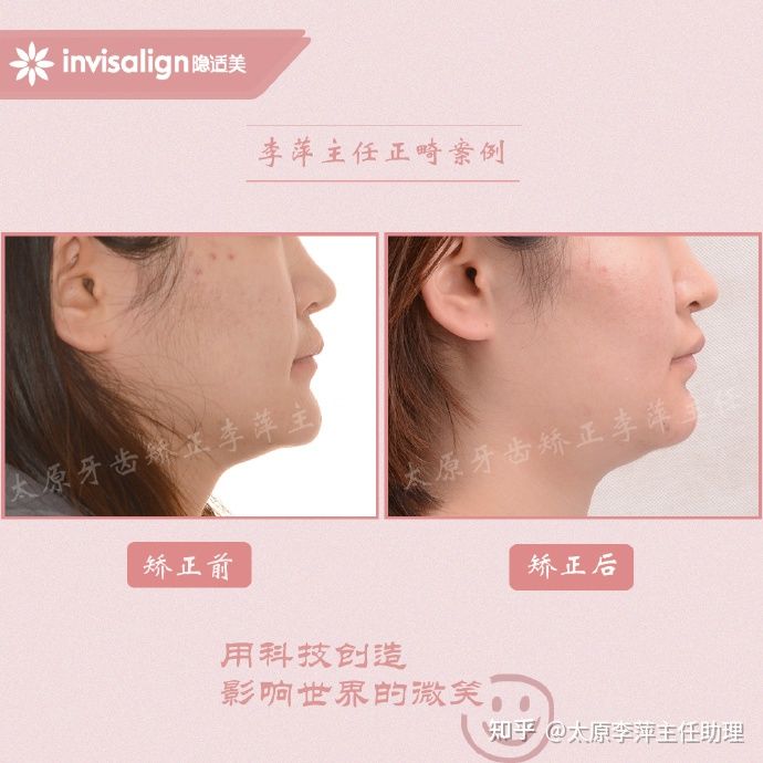 太原矫正牙齿需要做正颌吗,太原牙齿二次矫正
