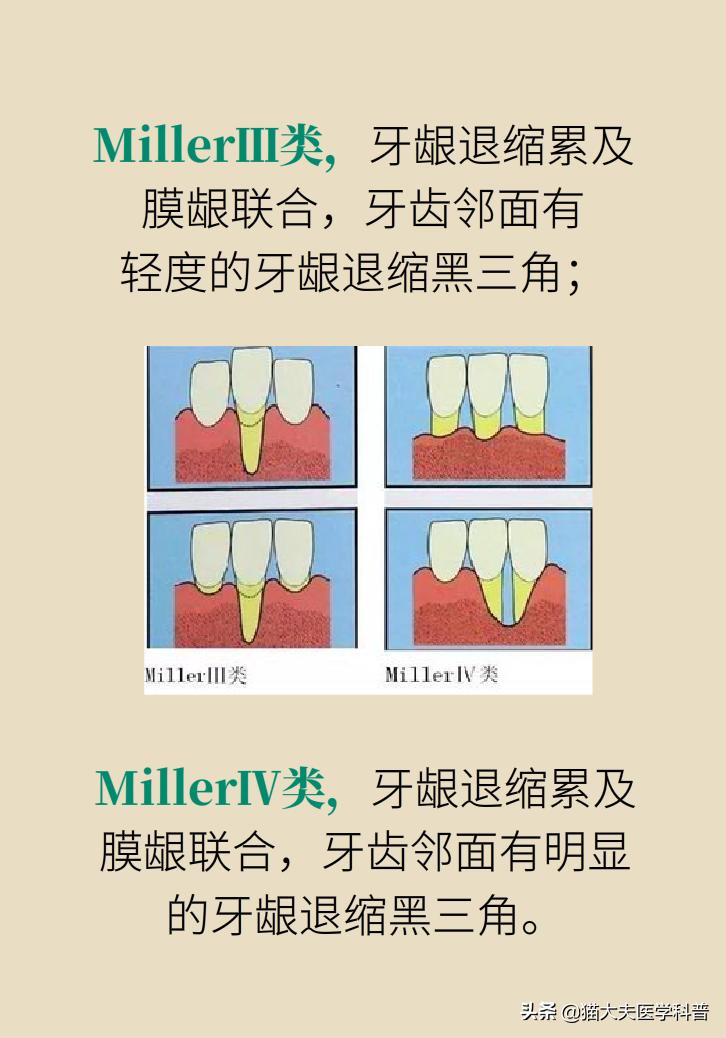 牙根露出来怎样修复不动刀,牙根暴露但没疼痛感怎么办