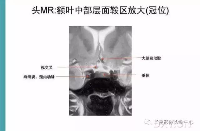 电子版头颅ct与mri断层解剖,头颅mri血管解剖与分段详解