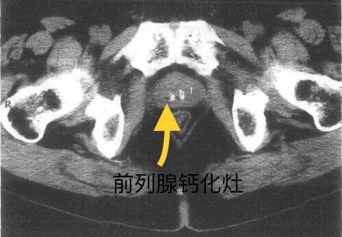 前列腺钙化灶可以用冲击波治疗吗,治疗前列腺钙化灶的药物有哪些