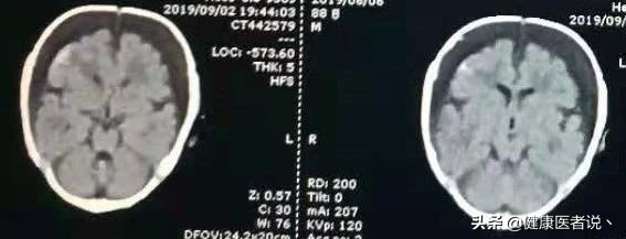 小儿头发卷曲，可能是患上了一种病...