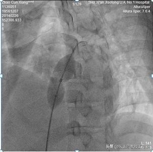 “躺平就好”四处求医愁煞人巧断病因封堵成功再登巅
