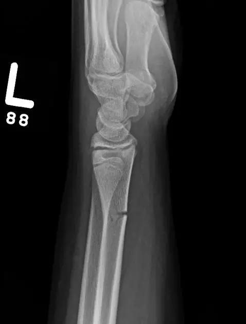 几种严重骨折医学名称,常见的骨折有哪些名称