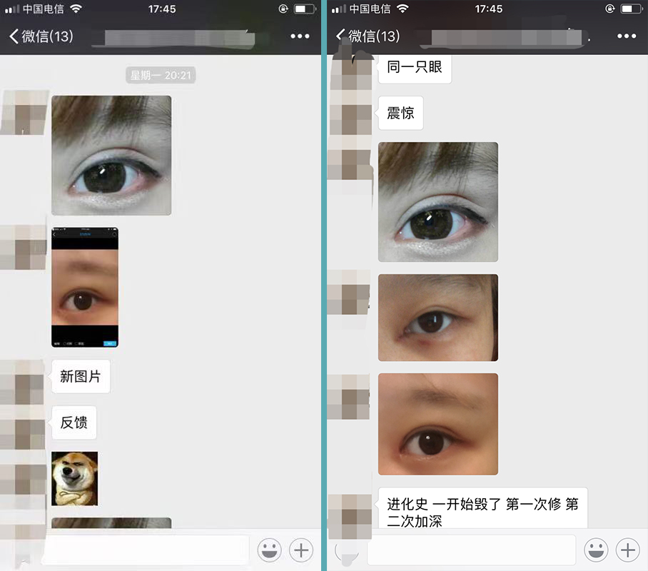 双眼皮太深显老怎么修复,双眼皮失败后修窄