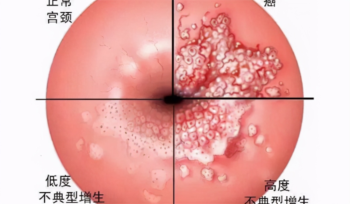 有宫颈糜烂可以打hpv疫苗吗,hpv感染合并低级病变