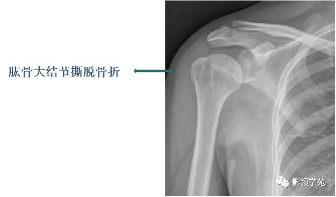 桡骨远端骨折引起尺骨变异,撕脱骨折一个月无明显骨痂形成
