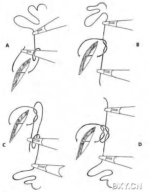 实用大全：腹腔镜下缝合与打结