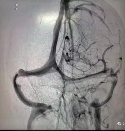 长治市人民医院成功完成一例颅内静脉支架植入术