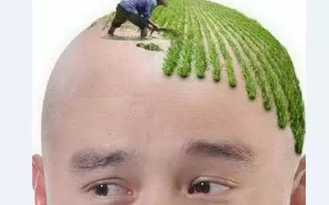 脱发能不能治好,要根据看你的脱发类型