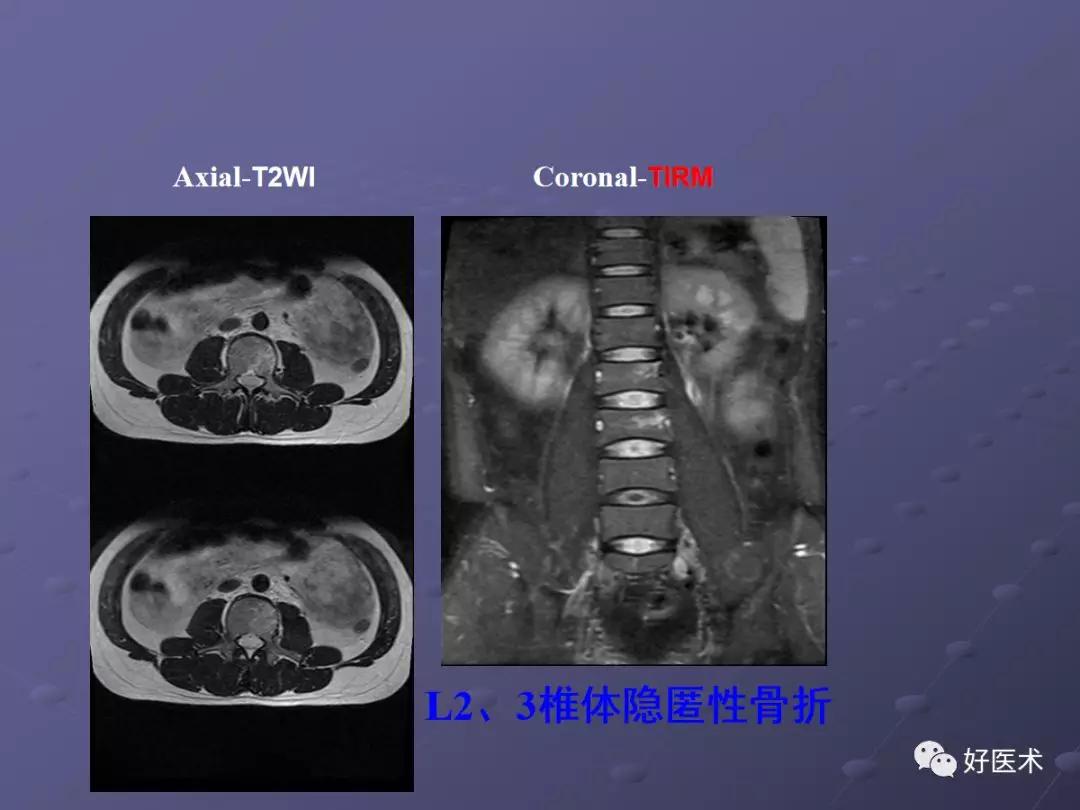 脊柱mri有哪些特点,乳腺疾病的mri诊断及鉴别