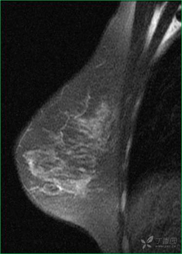 乳腺结节有消散的病例吗,一份完整的乳腺增生病例