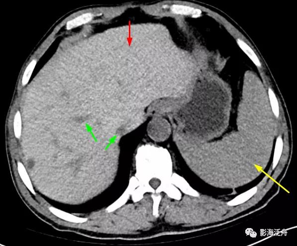 肝脏弥漫性病变严重吗,肝脏弥漫性的病变的症状