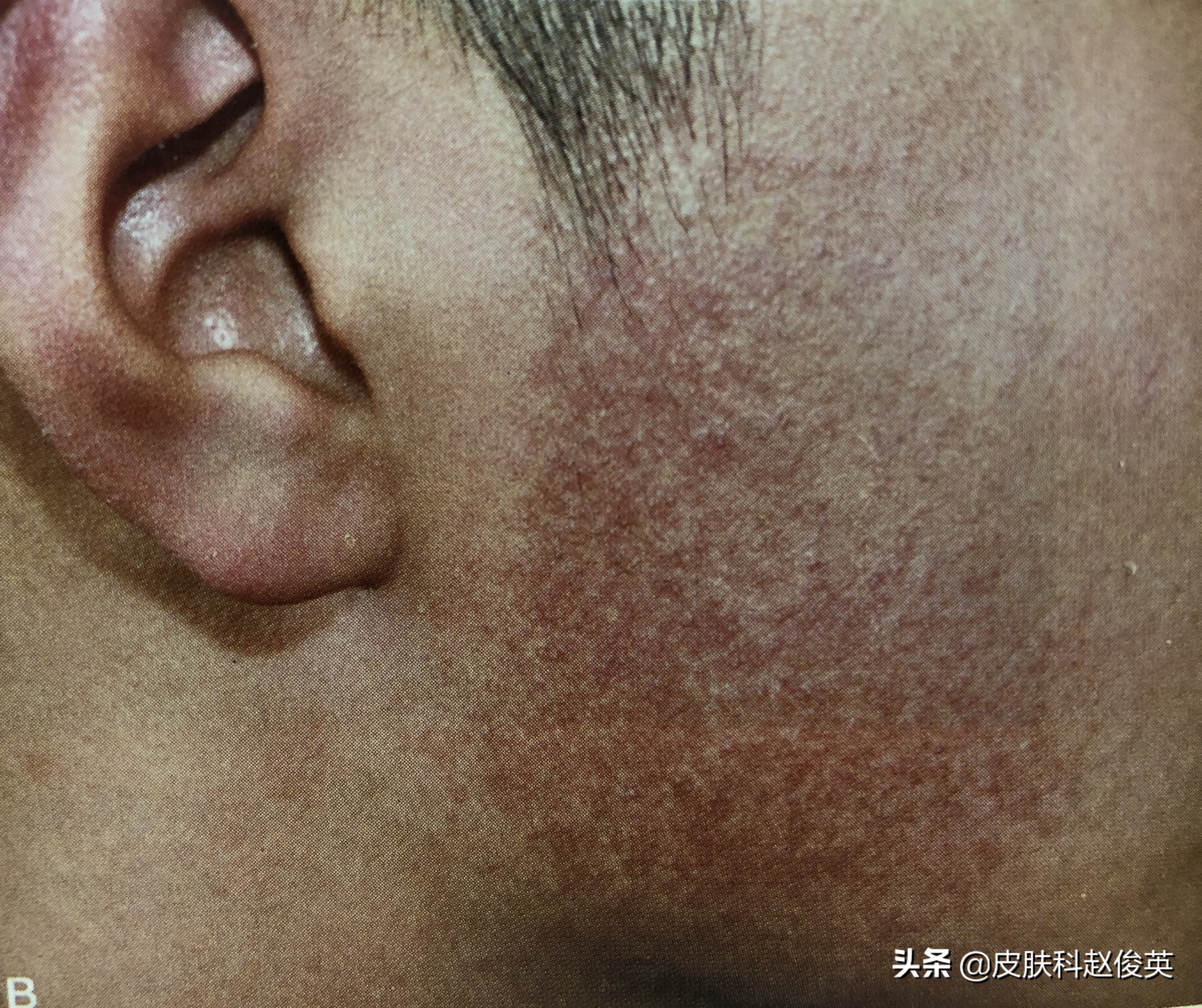 鸡皮肤太丑怎么办图片,鸡皮肤如何改善最有效