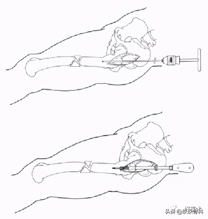 髓内钉技巧,髓内钉教学视频讲解