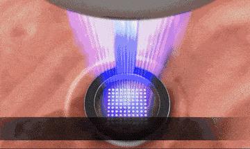 激光美容有哪些必要做,激光整形真相