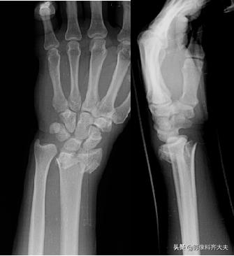 骨折的影像学检查及各自的优势,骨折的影像学愈合标准