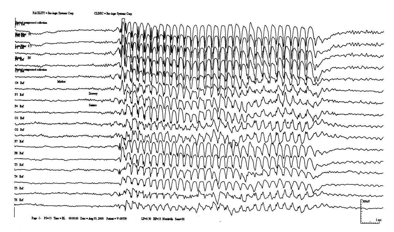 儿童发呆的癫痫咋治,孩子得了癫痫病为什么老是发呆