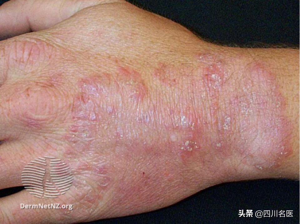 你的手为什么老脱皮,你的手为什么这么糙