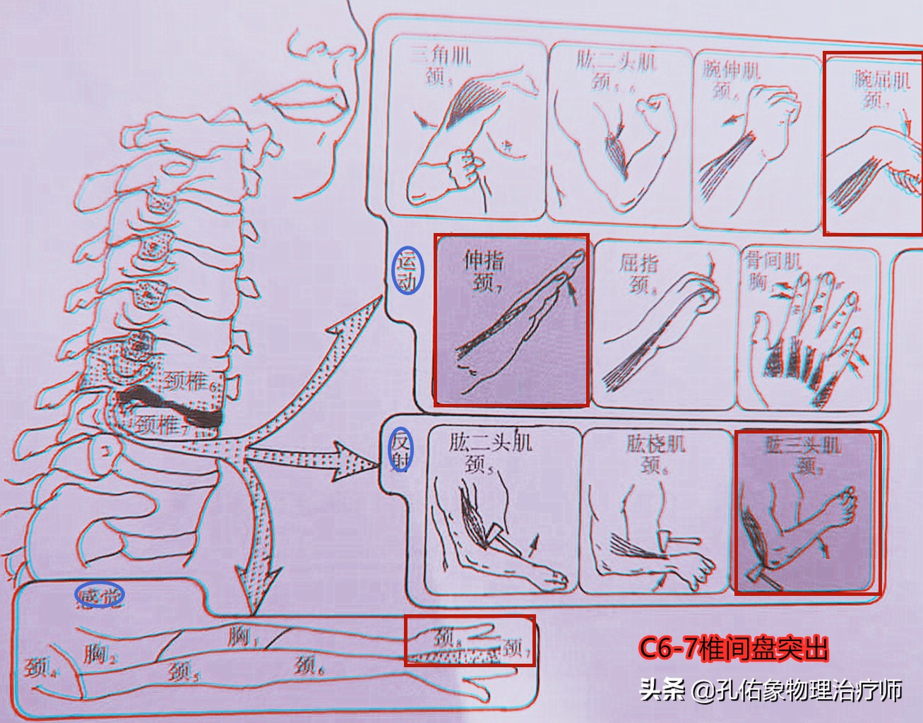 颈椎间盘突出手指尖麻乏力怎么治,颈椎间盘突出导致四肢无力疼痛