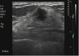 乳腺检查有疑似结节是什么意思,乳腺彩超报告中隐藏的秘密