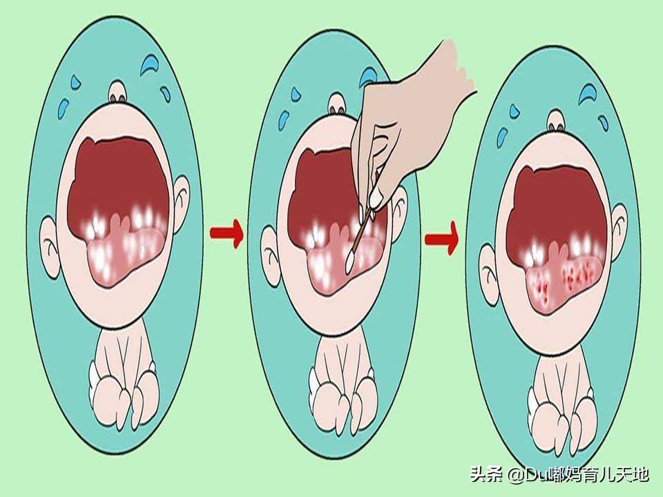 什么事鹅口疮？得了鹅口疮应该怎么办？