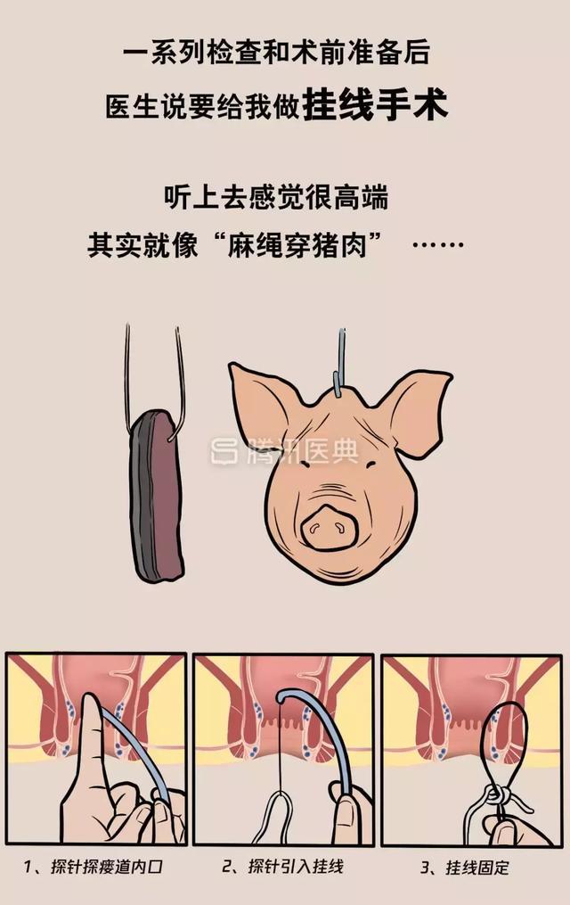 “*菊爆**后”痛到喊妈!真实看病经历泣血奉上,必须保护好菊花