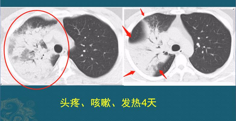 糖尿病不注意饮食的危害科普视频,糖尿病不忌口吃糖的后果