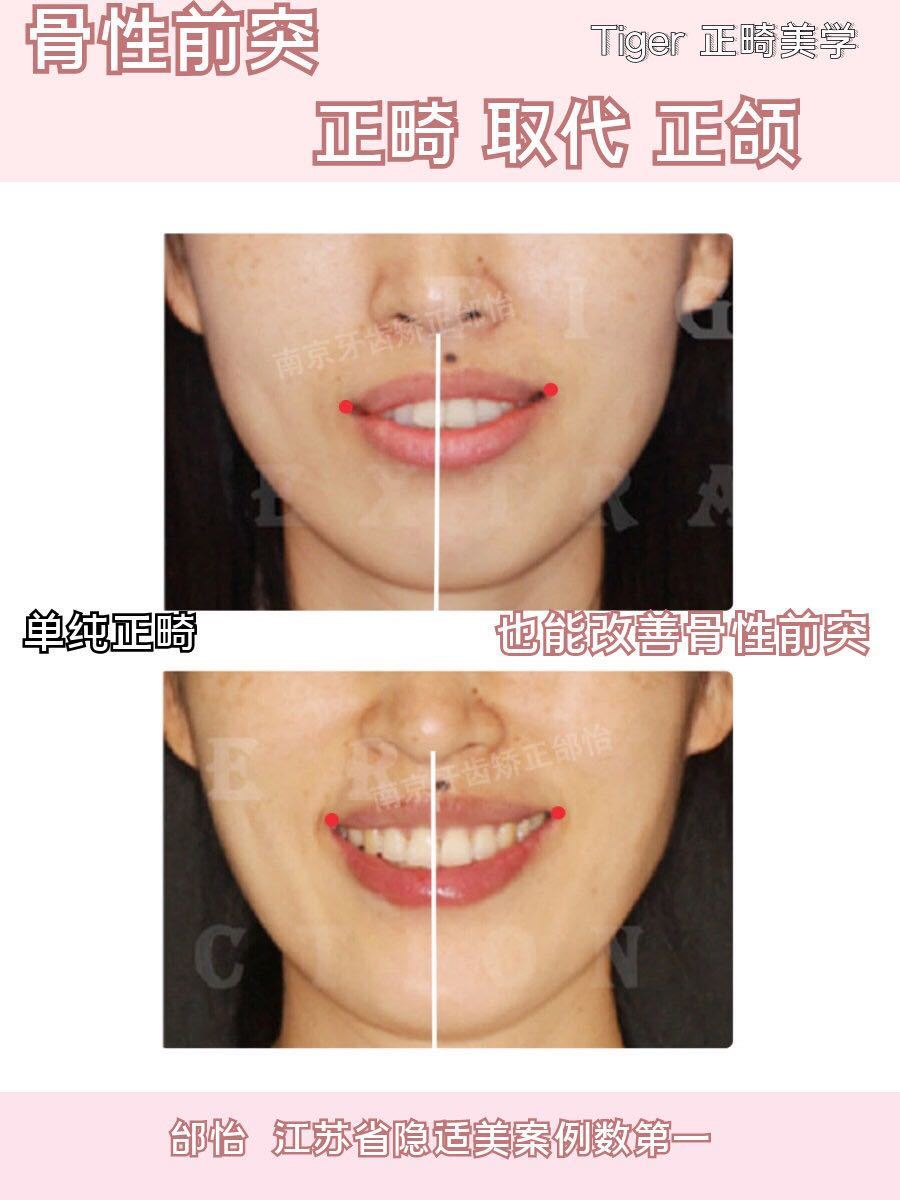 南京成人隐形牙齿矫正一般多少钱,隐适美牙齿矫正比较好的医院