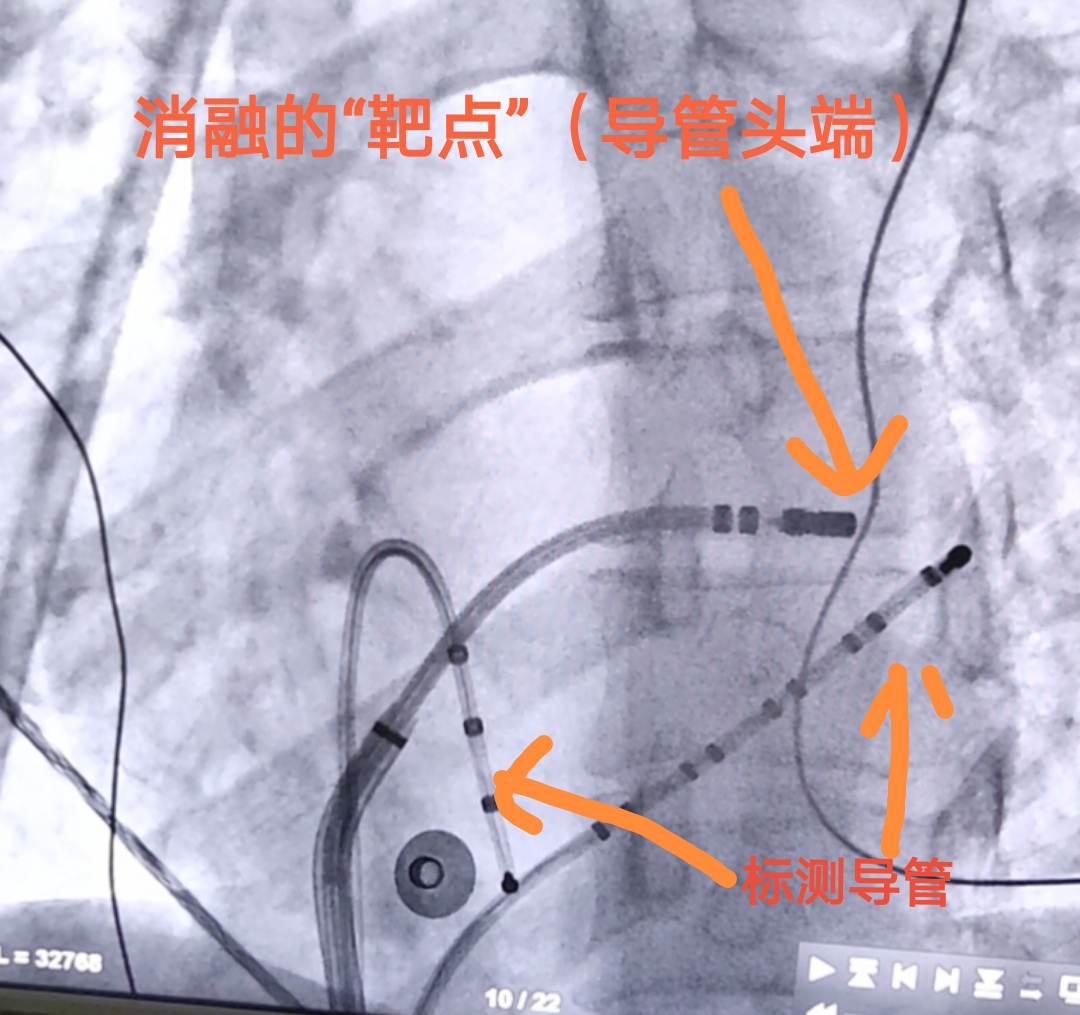 孕妇心动过速外加有点心肌缺血,怀孕心电图窦性心动过速心慌胸闷