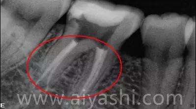已经有牙洞了怎么根管治疗,牙髓腐烂坏死再做根管治疗会痛吗