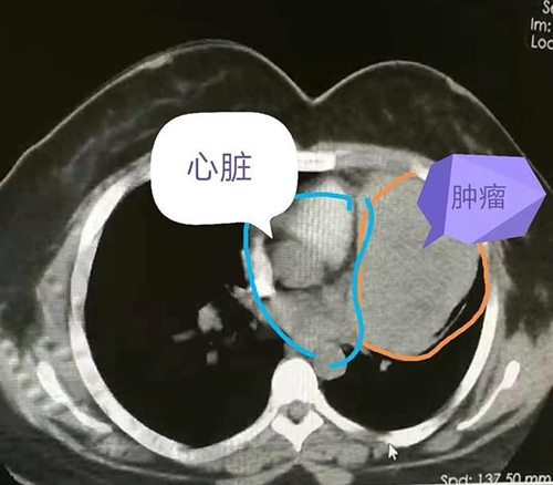 为了拼事业，延误纵隔肿瘤的治疗，差点造成不可挽救的后果
