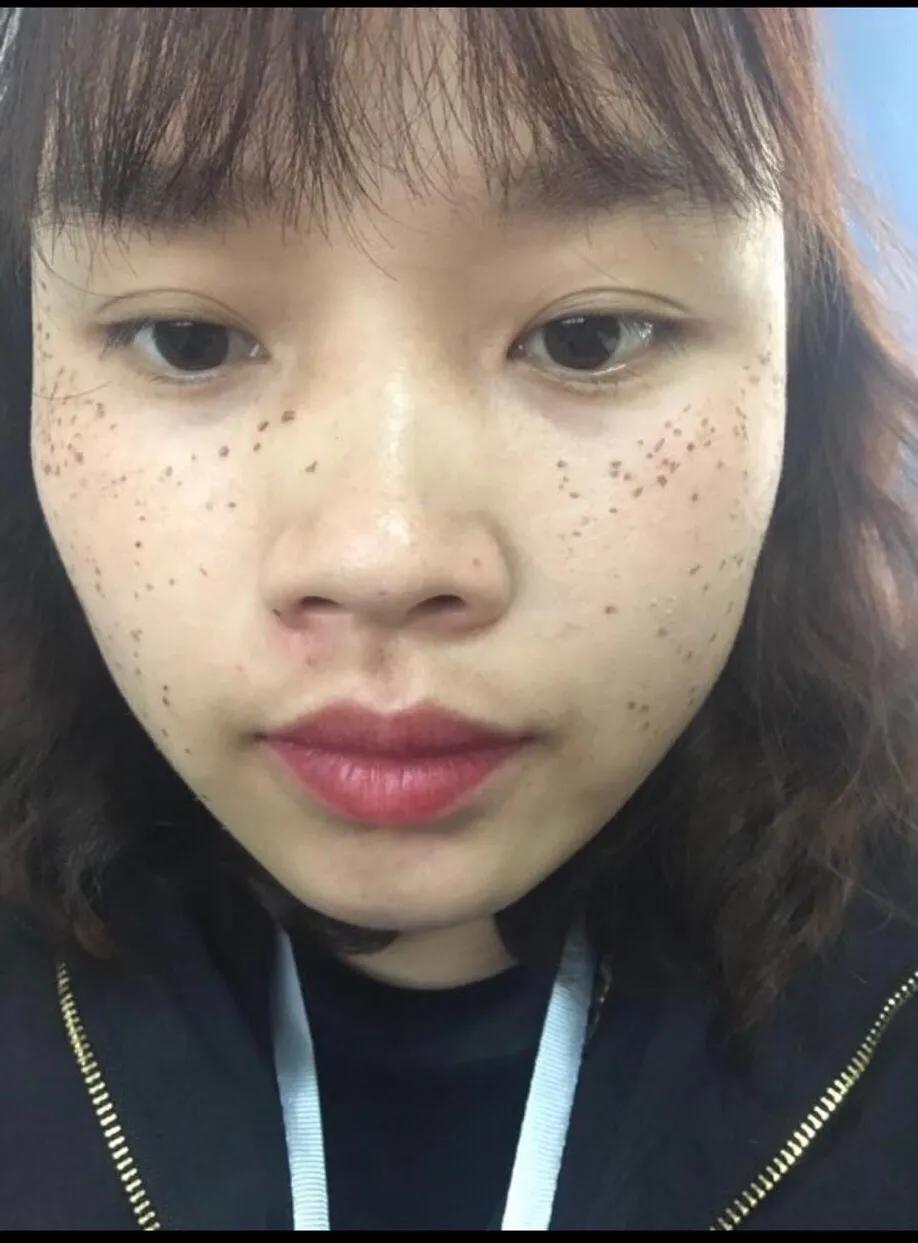 遗传性雀斑食疗方法,遗传性雀斑祛斑霜