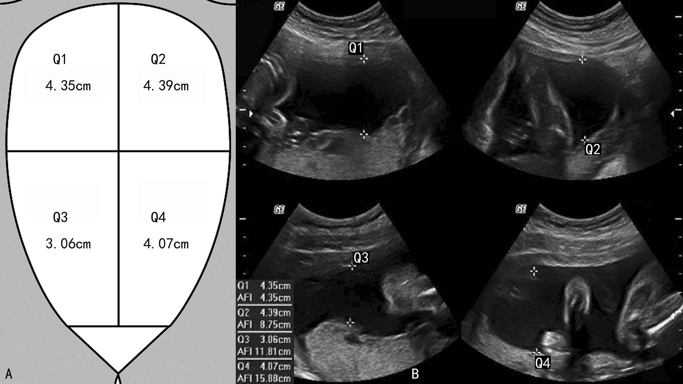 明明白白做超声(十九):羊水和胎膜超声检查