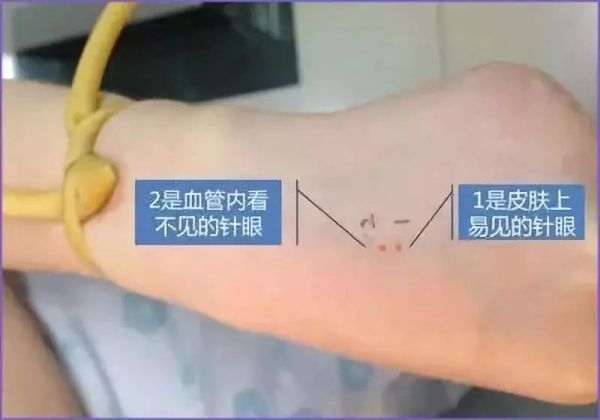 空气输入血管，会不会致死？输液针头回血了，怎么办？