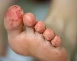 华法林不良反应,华法林钠的不良反应