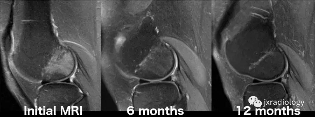 磁共振天天诊断骨髓水肿，但您知道原因吗？