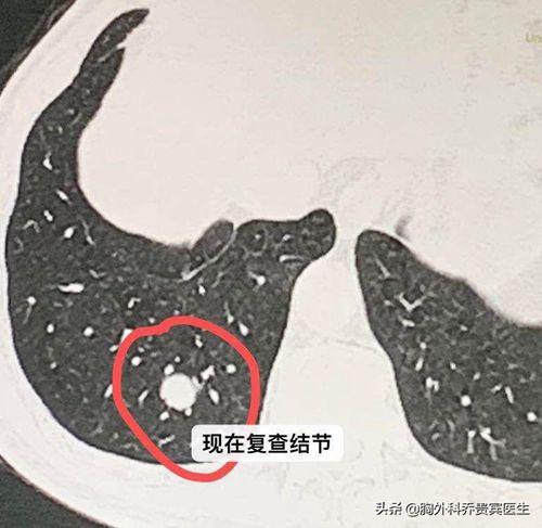 肺部结节半年增大1毫米是肺癌么,肺部有1.11cm结节是肺癌吗