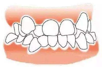 牙齿有黑三角会不会越来越严重,牙齿开始出现黑三角怎么办