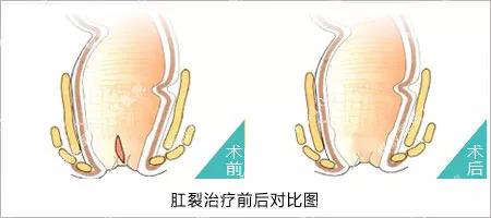 反复肛裂不见好怎么办,肛裂为啥老是开裂和痒