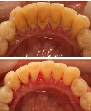 洗牙对牙齿有伤害吗能美白牙齿吗,洗牙美白的最快方法