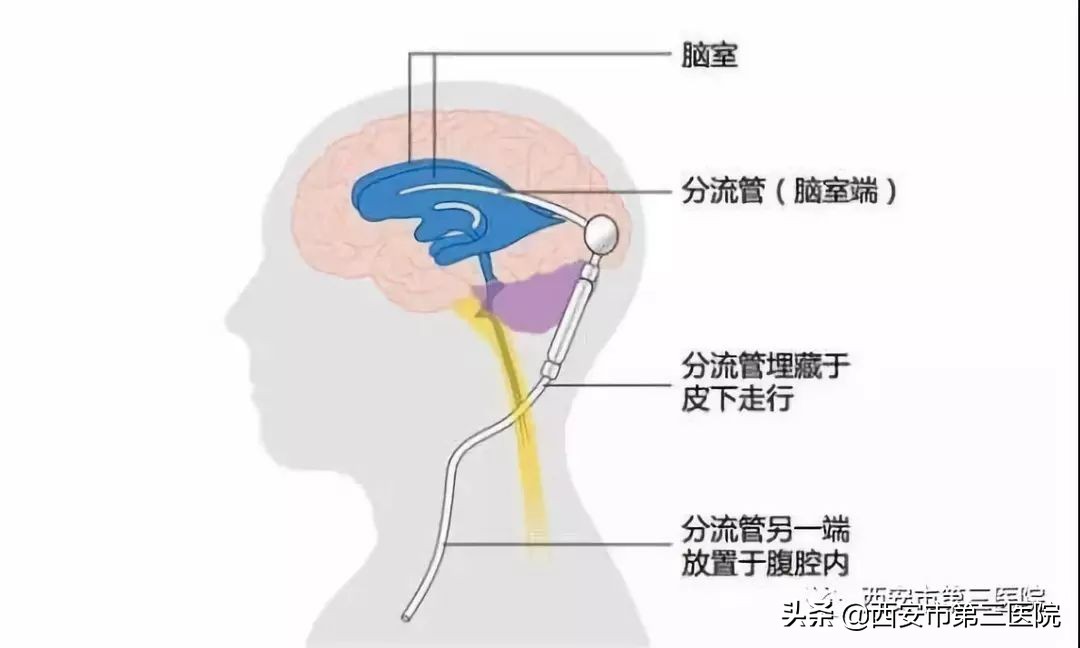 【科室与你】西北大学附属医院·西安市第三医院神经外科五大专病门诊