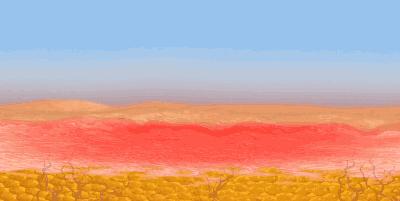 毛孔粗大满脸都是坑,毛孔粗大是糙皮病吗